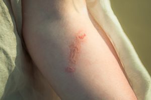 Guide pratique : Comment apaiser efficacement une piqûre de méduse ?